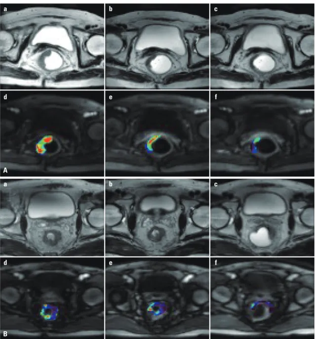 Fig. 5. Perfusion MRI imaging. (A) Good response. (B) Poor response.