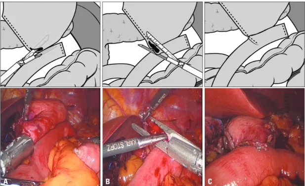 Fig. 2. Surgical techniques for gastrojejunostomy. (A) Side-to-side anastomosis between the greater curvature of the stomach and the je- je-junum with a linear stapler