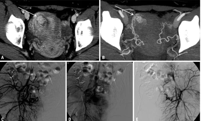 Fig. 1. A 26-year-old patient (No. 4) presenting with progressive vaginal bleeding. The axial enhanced CT scan (A) and CT angiography (B) show focal a hy- hy-pervascular lesion (arrows) with feeders from the right uterine artery