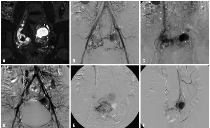 Fig. 2. A 21-year-old patient (No. 10) presenting with progressive vaginal bleeding. (A) The enhanced coronal MR image shows tortuosity of the right uterine  artery with a large pseudoaneurysm (arrows) at the uterine fundus