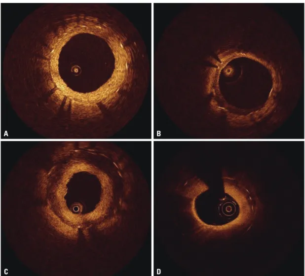 Fig. 1. Representative optical coherence tomographic images of neointimal tissue. (A) Homogeneous type