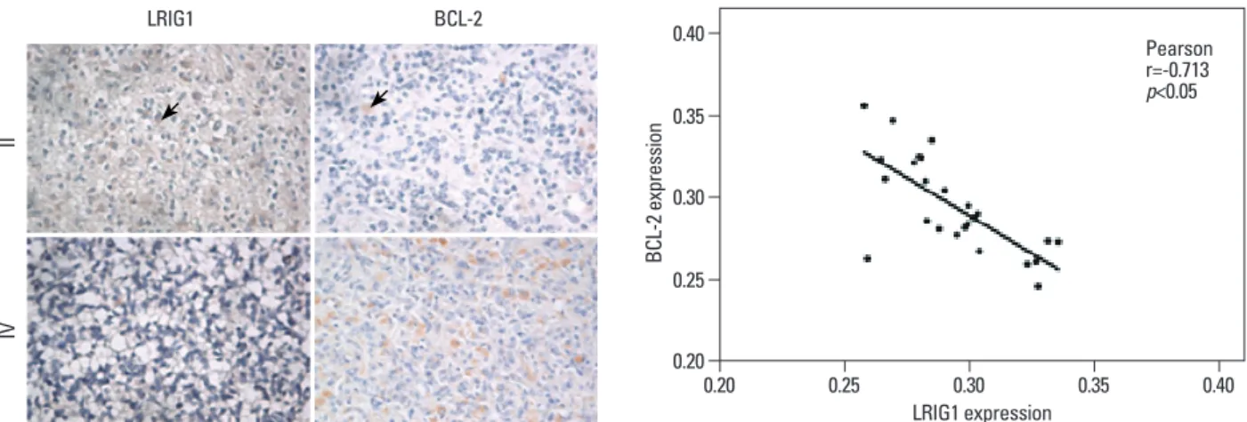 Table 2. The Expression of LRIG1 and BCL-2 in Astrocytic  Tumors Tissue (OD, mean±SD)