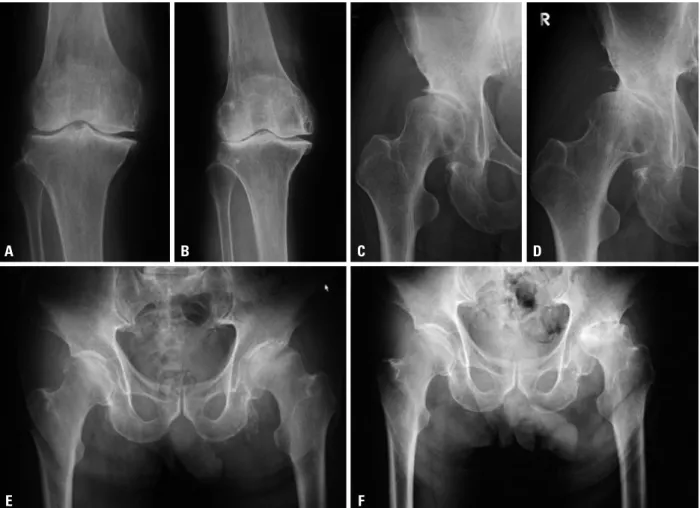 Fig. 2. An 84-year-old woman showed knee OA before treatment (A) and progressive changes in OA (B) 12 weeks after 25 µg/h transdermal fentanyl treat- treat-ment