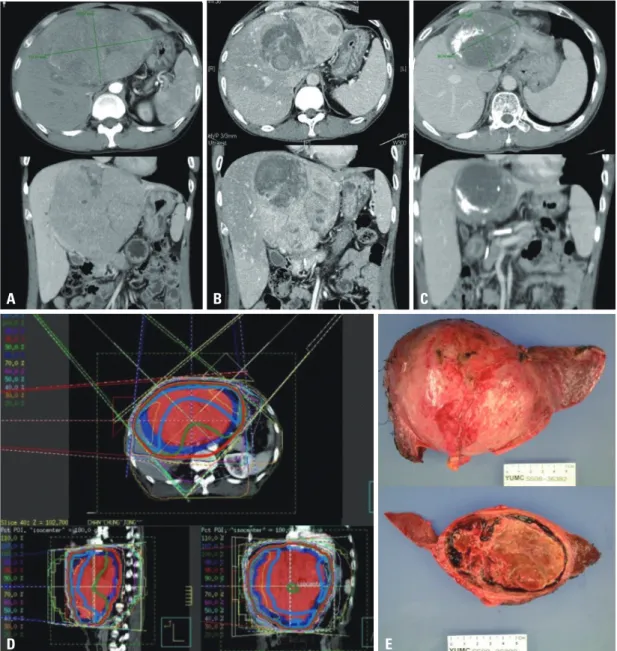 Fig. 1. A 51-year-old male diagnosed with 16 cm HCC in the left lobe, cT4N0M0, PVTT (+), iAFP 89.3 ng/mL; initially treated with TACE (A)