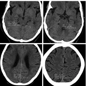 Fig. 1. The region of interests (ROI) measured at 3 or 4 points including right  sigmoid sinus (SS), Lt