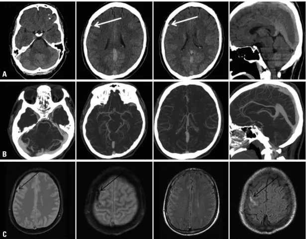 Fig. 7. A 31-year-old male presented with headache. The UECT (A) showed grossly hyperdense dural sinus, but mean density was mea- mea-sured as 51 HU and was well correlated with an Hgb level of 15.7 g/dL and an Hct level of 47.2%