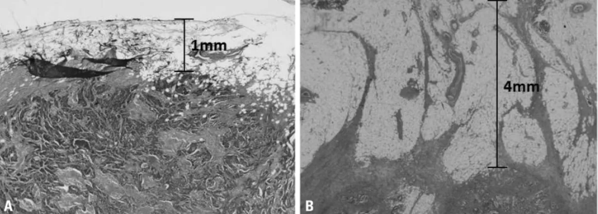 Fig. 1. Pathologic findings of the CRM-positive and CRM-negative groups. The distance between the tumor and the circumferential resec- resec-tion margin was 1 mm (H&amp;E staining, ×12) in the CRM-positive group (A), and 4 mm (H&amp;E staining, ×12) in the