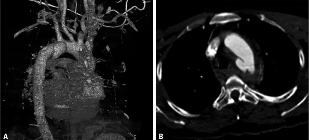Fig. 1. Pseudoaneurysm and its relationship with surrounding structures. (A) Saccular pseudoaneurysm was noted just distal to the ori- ori-fice of the LSA on the lesser curvature of the aorta on the three-dimensional reconstruction image of the CT