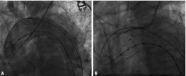 Fig. 2. Endograft deployment resulted in near-total coverage of the LSA (A), followed by retrograde chimney stenting of the LSA origin via  the trans-brachial approach (B)