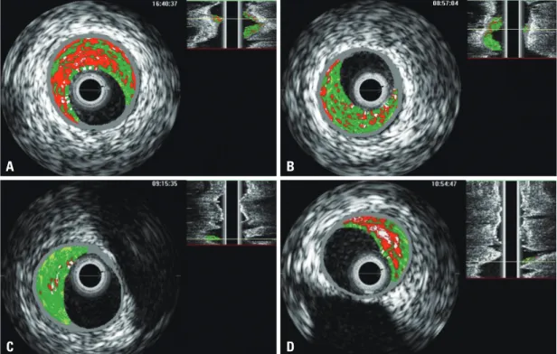 Fig. 2. Change in percentages of the four plaque components in TCFA  (n=14) during 6-month follow-up