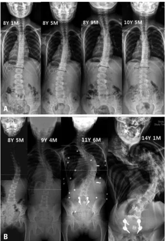 Fig. 1. (A) A female patient (8 years 1 month) when first discovered in had a  Cobb’s of 12.5 degrees