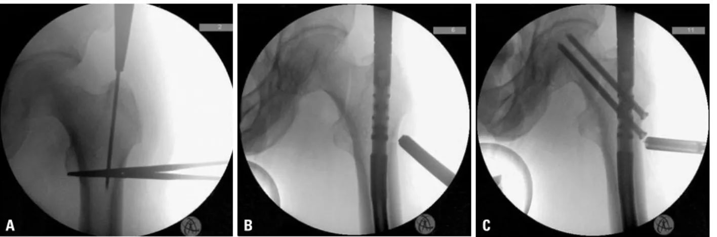 Fig. 1. (A) A 3.2-mm guide pin was inserted at the tip of the greater trochanter; the radiolucent line was not visible at that time