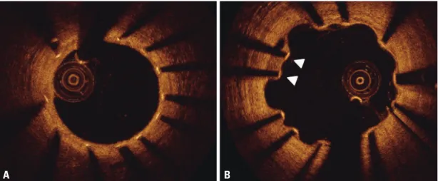 Table 1 summarizes the strut apposition and coverage of  various DESs. Compared to sirolimus-eluting stent, the  coverage of Endeavor zotarolimus-eluting stent was almost  complete at 3 months