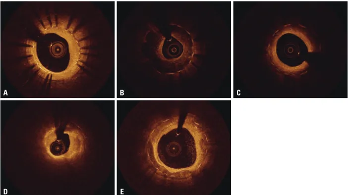 Fig. 3. Various patterns of neointimal tissue. (A) Homogeneous pattern, (B) heterogeneous pattern, (C) layered pattern, (D) lipid-laden neointima, (E) neointi- neointi-ma with calcification.AD BE C
