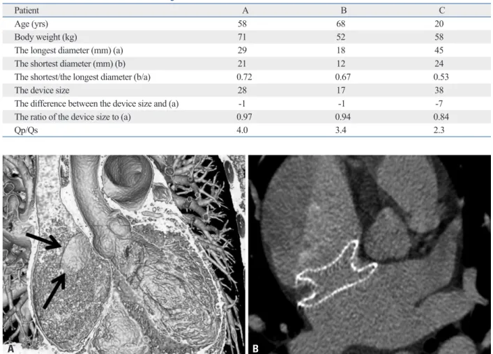 Table 3. The Characteristics of the Oval Shaped Atrial Septal Defects in Three Patients with Negative Number of the Differ- Differ-ence between the Device Size and the Longest Diameter of the Defect