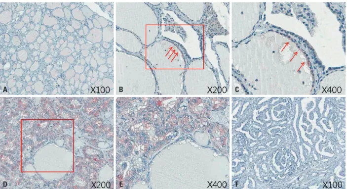 Fig. 1. Immunohistochemical staining of NQO1 in the normal thyroid and PTMC. (A) NQO1 was rarely detected in normal thyroid follicles