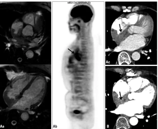 Fig. 2. (Aa) Heart MRI showing a low-density mass lesion from the SVC and RA junction (left panel) to the right atrium of the heart (right  panel)