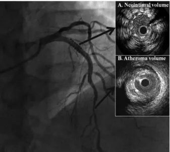 Fig. 1. IVUS image for measure of neointimal volume at in-stent lesion (A)  and atheroma volume at another target lesion (B)