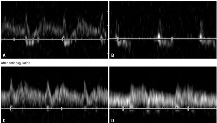 Fig. 2. (A) Initial Doppler ultrasonography of the left vertebral artery shows bidirectional wave