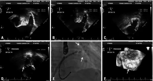 Fig. 2. Intra-procedural TEE images before (A, B and C) and after (D) deployment of LAA occlusion device