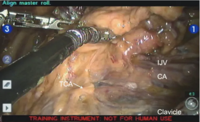 Fig. 2. Surgical view. SAN, spinal accessory nerve; BP, brachial plexus; CA,  carotid artery.