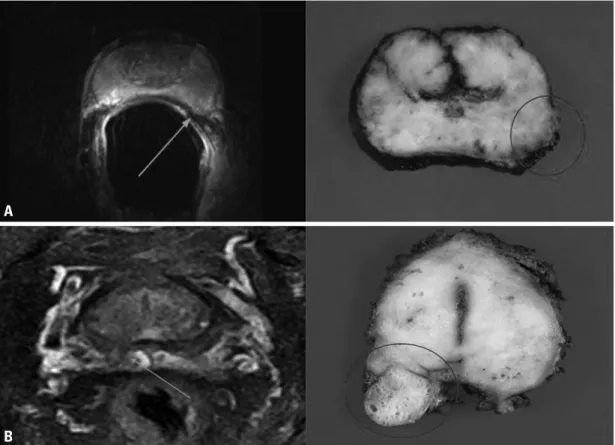 Fig. 1. Comparison of a T2-weighted fast spin-echo magnetic resonance image at 3 Tesla and a corresponding axial whole-mount-sec- whole-mount-sec-tion histopathologic slice (A) example of a tumor with a 2-mm radial distance of extracapsular extension (arro