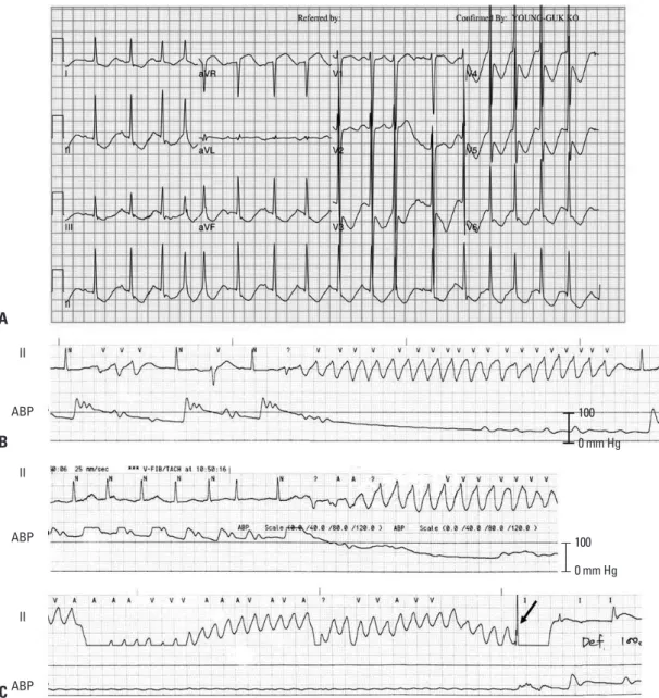 Fig. 1. ECG and arterial blood pressure recording. (A) The 12-lead ECG at the emergency room shows a markedly prolonged QT interval  (QTc=635 ms)