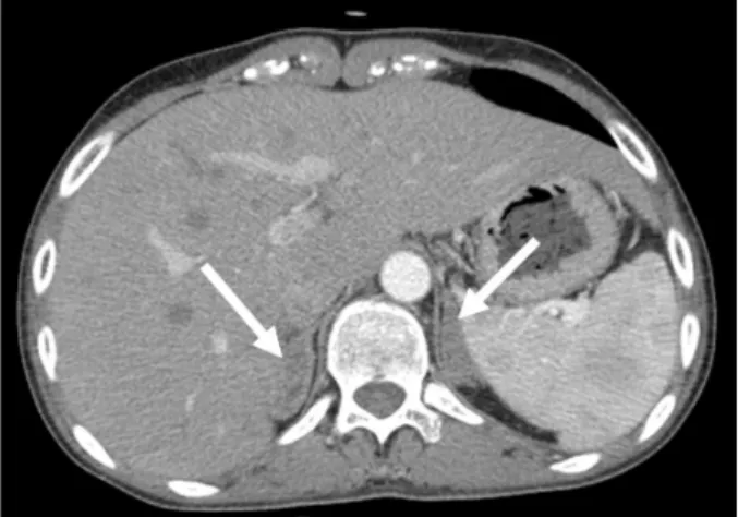 Fig. 2. Abdominal computed tomography showed bilateral hyperplasia of  adrenal glands (arrows).
