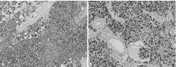 Fig. 2. Immunohistochemical staining showed diffusely strong staining for synaptophysin (A) and Ki-67 (B).