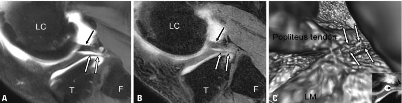 Fig. 1. MR arthrographic appearance of the meniscofibular ligament (MFibL). (A and B) A sagittal fat suppressed T1 weighted image of MR arthrography (A)  and a corresponding sagittal 3D gradient echo MR arthrography (B) demonstrate the MFibL as a linear hy