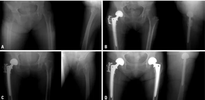 Fig. 1. A 69-year old woman had a subsequent fracture on the left side after a right side intertrochanteric fracture (initial T-score -5.3)