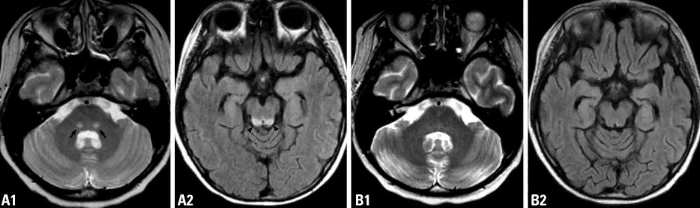 Fig. 2. (A) Increased signal intensity on the bilateral medial lemnisci of the dorsal pons (arrow, T2 weighted image, A1) and the colliculi of the dorsal midbrain  (arrow head, FLAIR, A2)