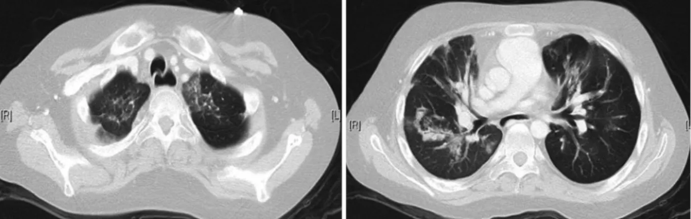 Fig. 1. Chest computed tomography. Diffuse bronchiectasis and airtrapping in both lungs with peribronchial graund glass opacity more predominantly in  both upper lobe