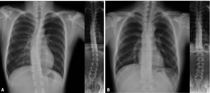 Fig. 1. Different scoliosis curve pattern according to chest radiographs and thoraco-lumbar standing radiographs (TLSR)
