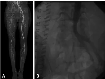 Fig. 2. The 10×0.5 cm sized organizing thrombi after Redo-Fogarty embolec- embolec-tomy.