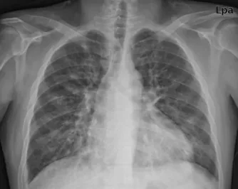 Fig. 2. Fundoscopic examination showing multiple cotton wool spots and a splinter hemorrhage.