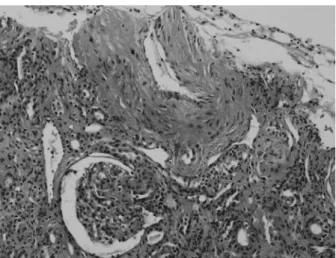 Fig. 3. Light microscopy examination showing intima fibrous hyperplasia,  smooth muscle cell hyperplasia in the media of interlobular artery, and a  collapsed glomerulus by ischemia (H&amp;E ×200).