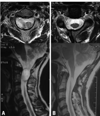Fig. 1. (A) Preoperative MRI of Case 9 showing extradural neurinoma of the  upper cervical spine