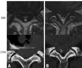 Fig. 5. Typical examples of discrepancies between CTM and MRI in severe  stenotic levels