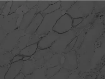 Fig. 1. Skeletal muscle, left vastus laterals: increased size variability and  degenerating fibers were revealed