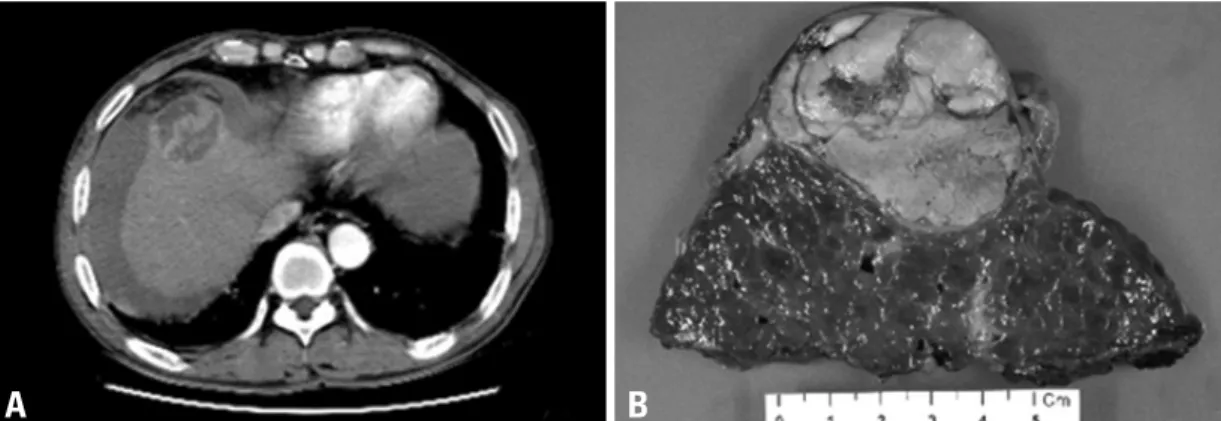 Fig. 2. A CT scan demonstrates a ruptured HCC located in segment VIII of the liver (A)