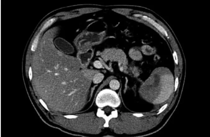 Fig. 1. Abdominal CT showing a loculated fluid collection in the lower pole  of the spleen