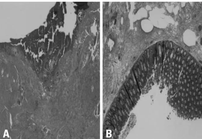 Fig. 3. (A and B) Submucosal edema and serosal hemorrhage of the perfo- perfo-rated sigmoid colon.