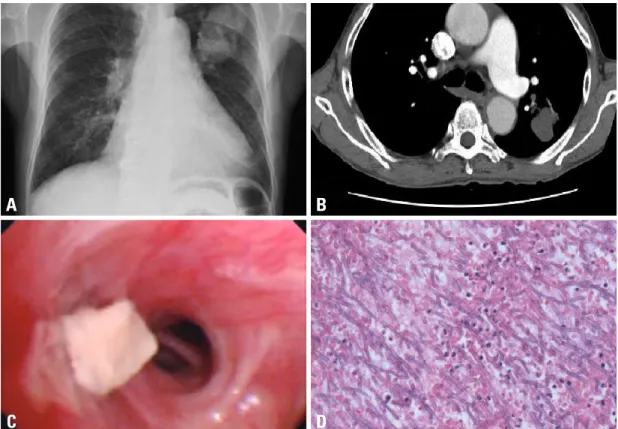 Fig. 1. Patient 1 (A) Chest radiograph of a 75-year-old man shows a large mass like shadow in the left upper lobe