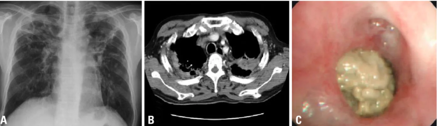 Fig. 3. Patient 6 (A) Chest radiograph of a 46-year-old man shows multiple calcified nodule and fibrotic changes with volume loss in the both lung zones