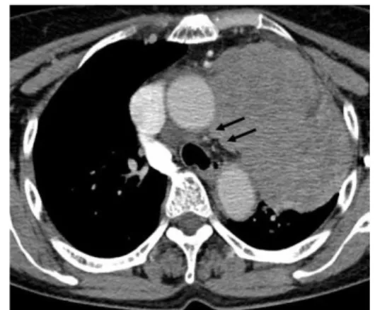 Table 4. Thirty-three of 36 patients with thoracic diseases had  unilateral VCP, 21 (63.6%) had left-side paralysis, and 12  (36.4%) had right-side paralysis