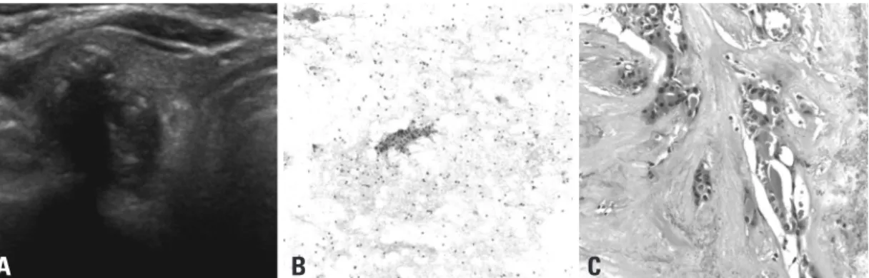 Fig. 3. A 61-year-old female with papillary thyroid carcinoma. (A) Ultrasonography shows an irregular and marked hypoechoic nodule  with a shape that is taller than it is wide and internal mixed calcification in the right thyroid gland; this nodule was con