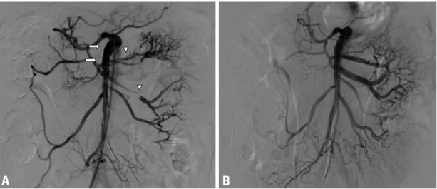 Fig. 2. (A) The first frame of the initial SMA angiography shows a focal dissecting flap 2 cm distally from the origin (arrow), aneurismal  change of the proximal SMA (arrow heads), and narrowing of the distal trunk of the SMA