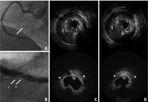 Fig. 2. Coronary angiogram and OCT findings at 12-month follow-up. (A)Coronary angiogram shows no restenosis in the stented segment