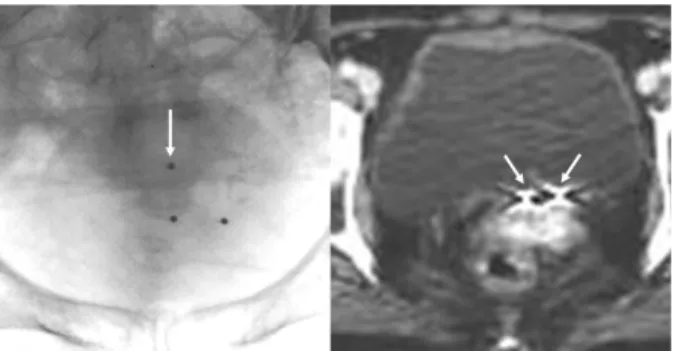Fig. 1. Fluoroscopy and planning CT image of three gold markers placed in a patient. 